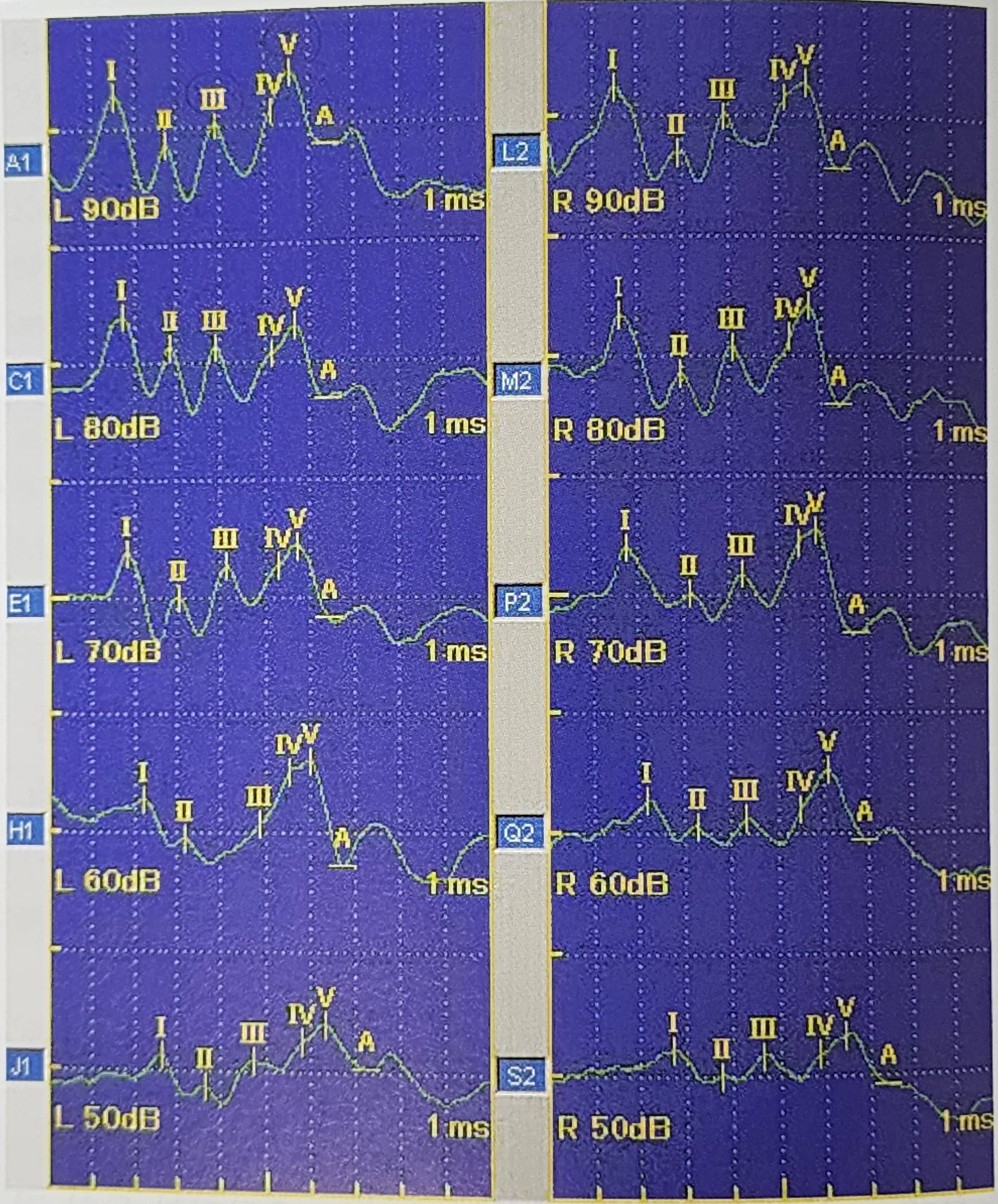 수술 중 신경계 감시에 대한 이해와 중요성
