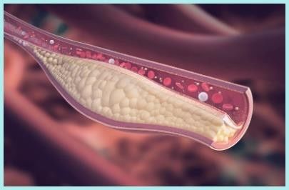triglycerides 정상 수치