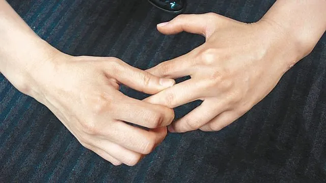 손가락 관절염 증상