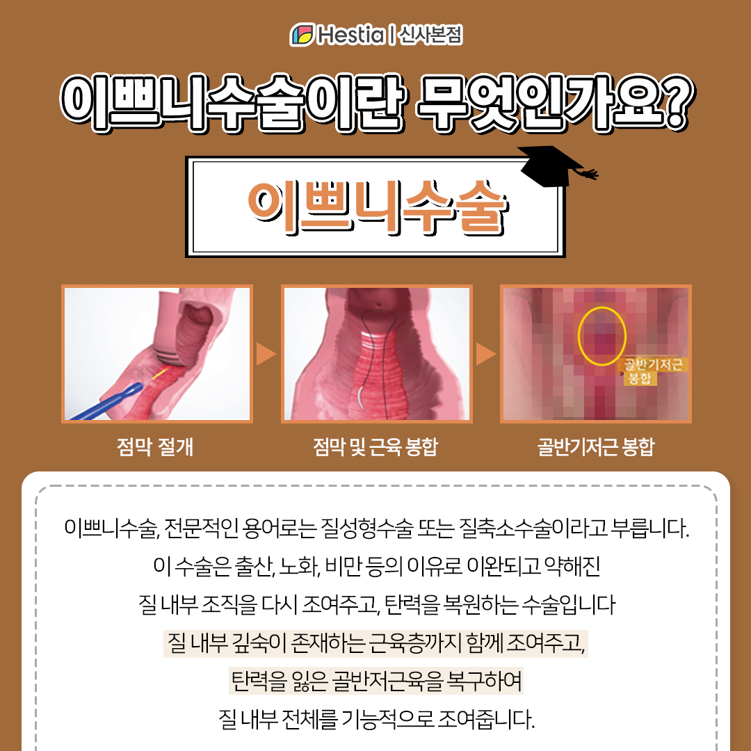 이쁘니수술이란?