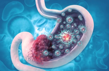 위암 초기평소증상