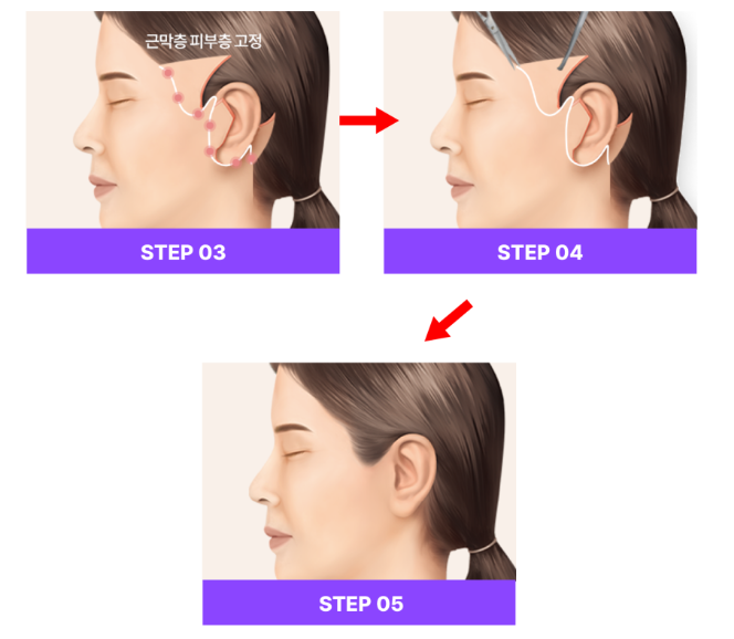 강남역성형외과 스마일거상 수술방법