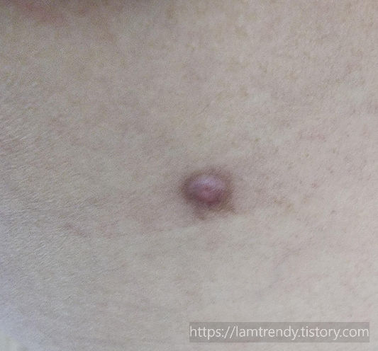 쥐젖냉동치료 10일차