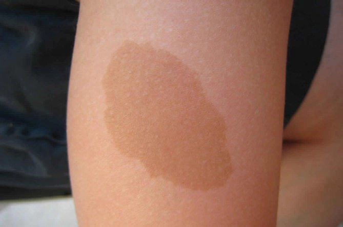 신경섬유종 밀크반점 증상 7가지 및 신경섬유종 커피반점 제거수술 치료