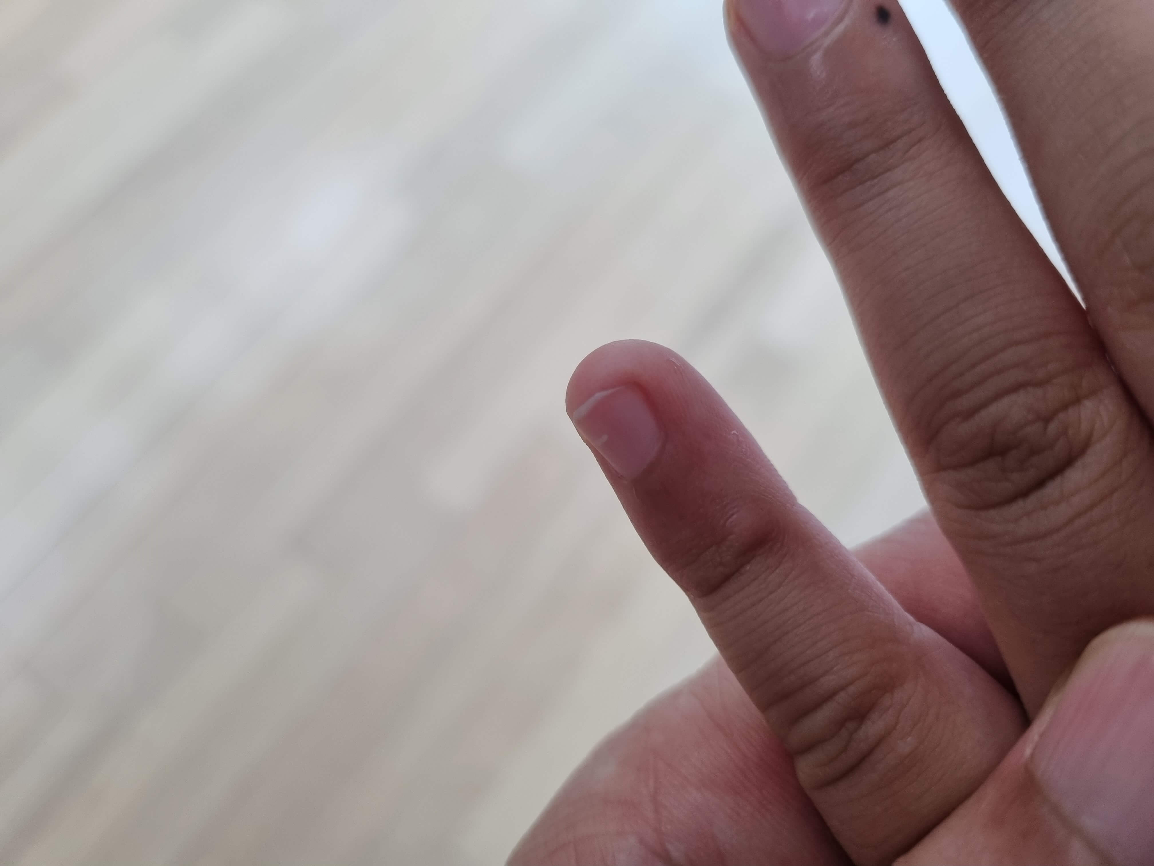 굳은살