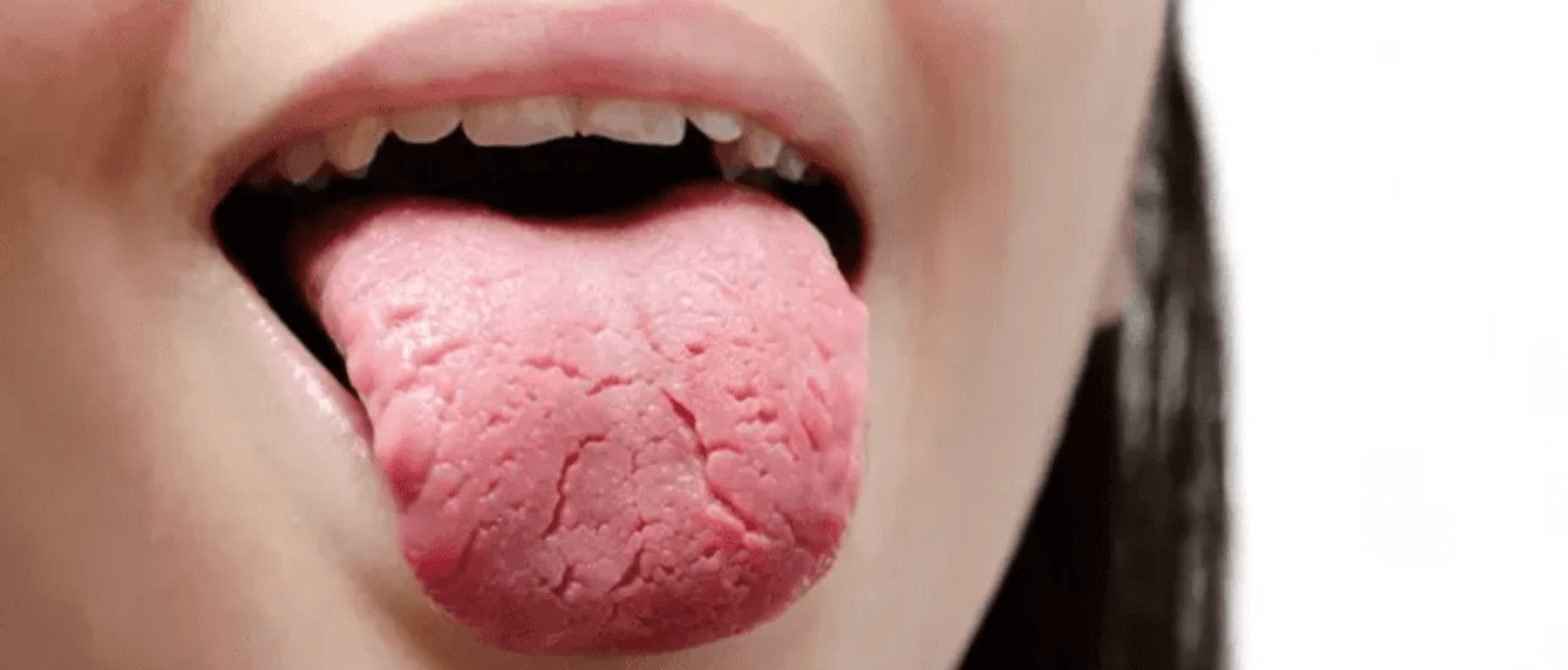 혀 갈라짐