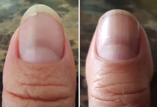 손톱으로 보는 건강상태