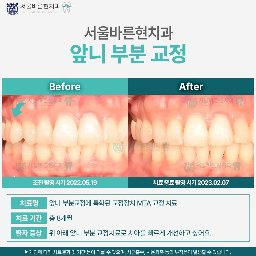 부산치아교정