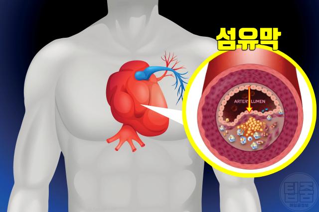 심근경색 전조증상 송대관 사망 원인