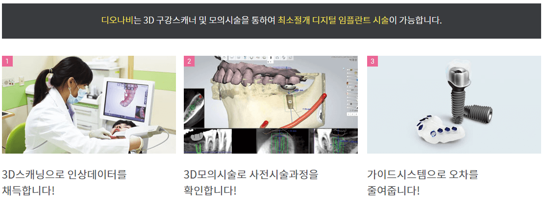 디오 임플란트 종류