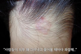 지루성 두피염