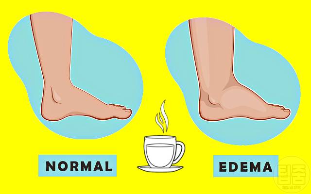 다리붓기 빼는 차 붓기빼는음식