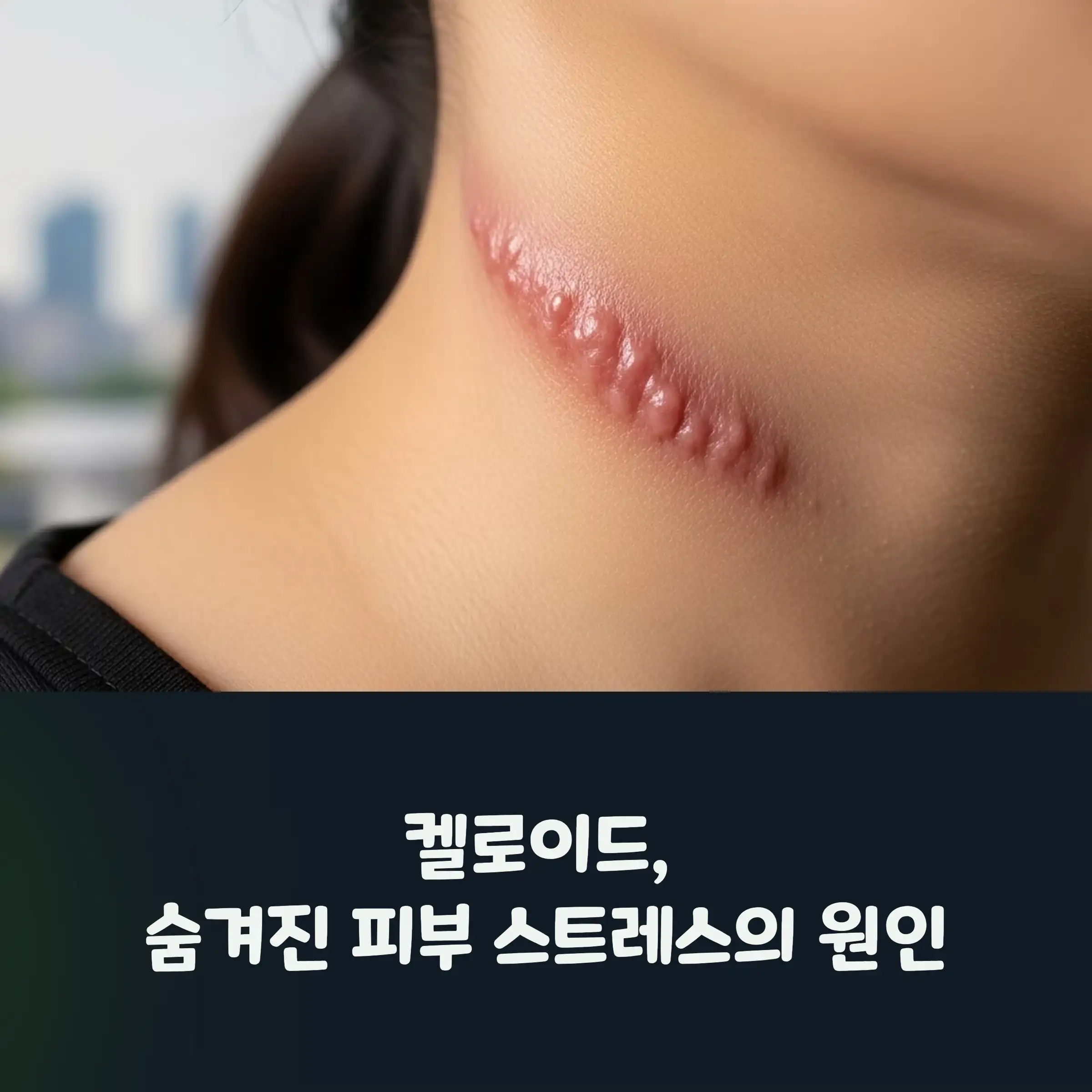 목에 있는 켈로이드 흉터의 모습