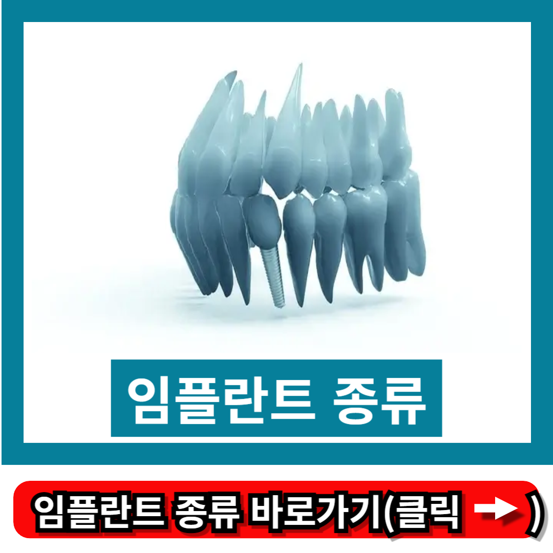 임플란트 종류