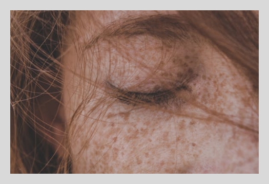 히알루론산 부작용