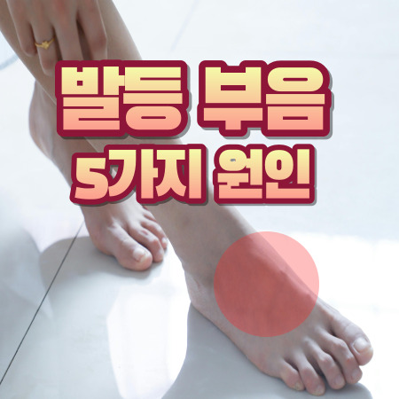발등 부음 5가지 원인