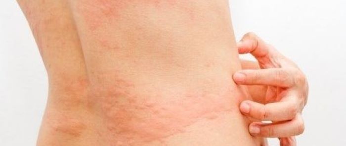 대상포진, 조기 치료가 답이다 (대상포진의 원인과 발병 과정 / 초기 증상에서 놓치지 말아야 할 신호 / 조기 치료와 합병증 예방법), 대상포진에 대해 설명하고 있습니다.