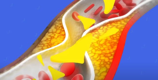 triglycerides 정상 수치