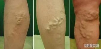 하지 정맥류 증상 치료방법과 예방 생활습관_8