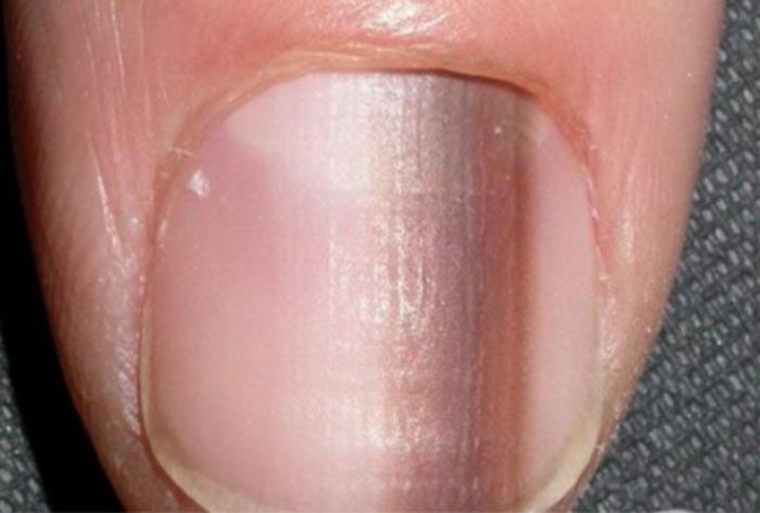 손톱에 세로줄이 생기는 이유