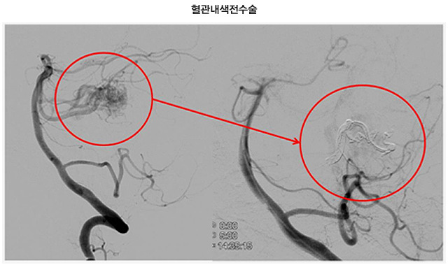 뇌 동정맥 기형 뇌출혈