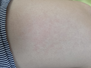 다이어트 중 갑자기 피부가 가렵다면? 키토 발진(색소성 소양증) 알아보기