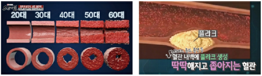 혈관노화