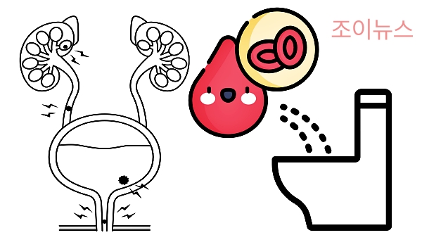 방광염 증상, 혈뇨