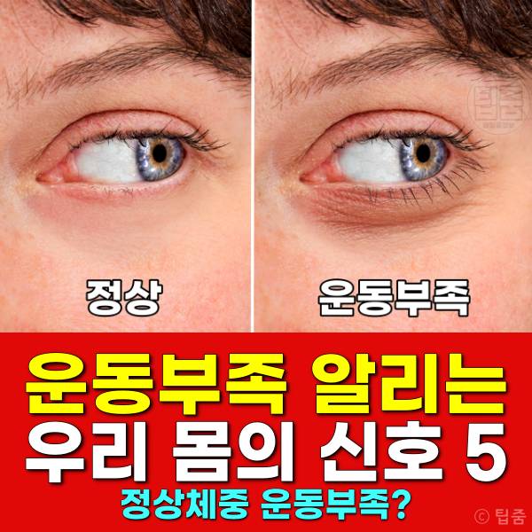 운동부족 증상 병 테스트,눈 밑 붓기