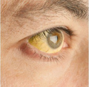 담도암 증상 초기 증상