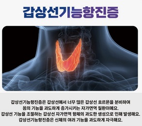 갑상선기능항진증