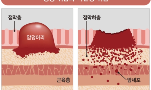 위암 이미지