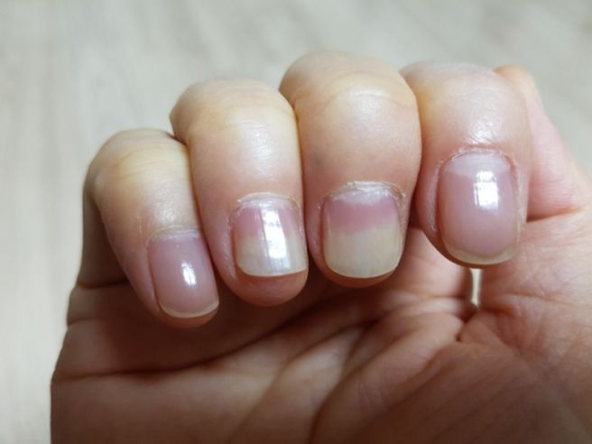 손톱 세로줄 무늬