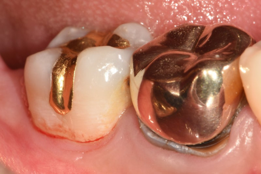 금니 팔기 전 시세 확인하기