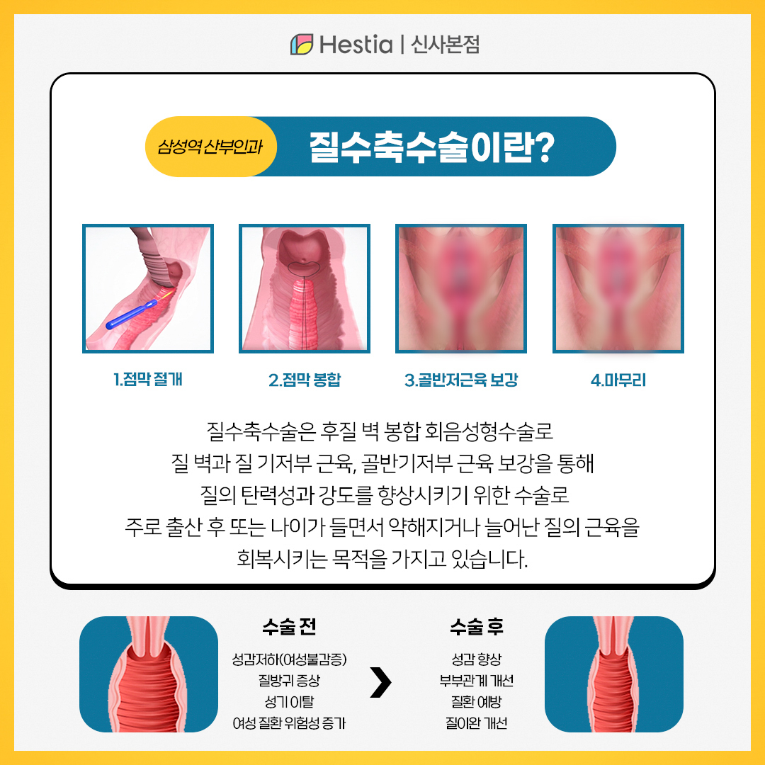 질축소수술이란?