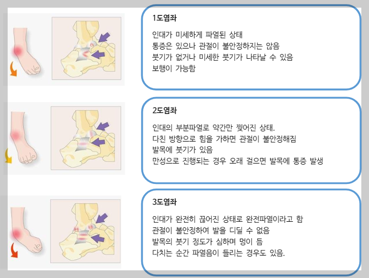 발목염좌손상구분