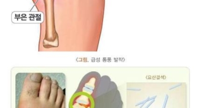 통풍이미지