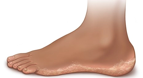 만성과각화성 발무좀 (Moccasin type)