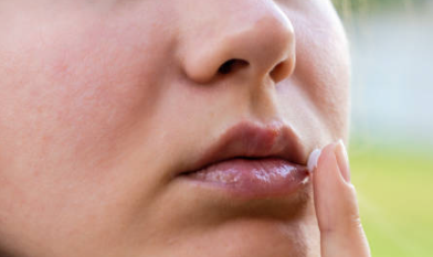 구내염 원인 치료법 구내염에 좋은 음식 증상 전염성