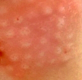 리쥬란힐러엠보2