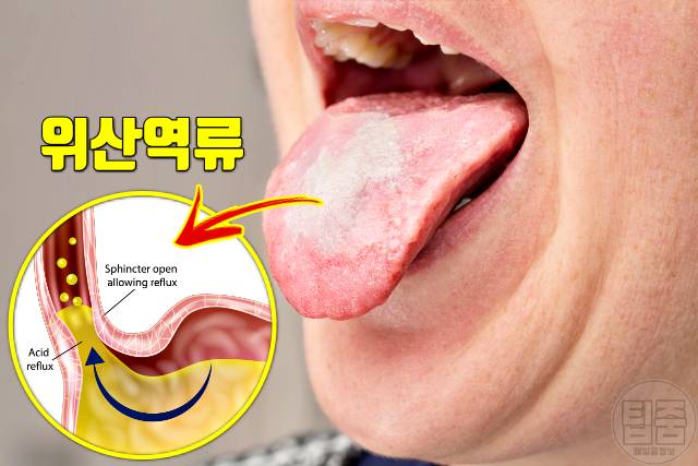 입냄새로 알아보는 건강 시큼한 입냄새 역류성식도염