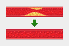 콜레스테롤 낮추는 방법 10가지