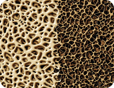 골다공증-치료방법