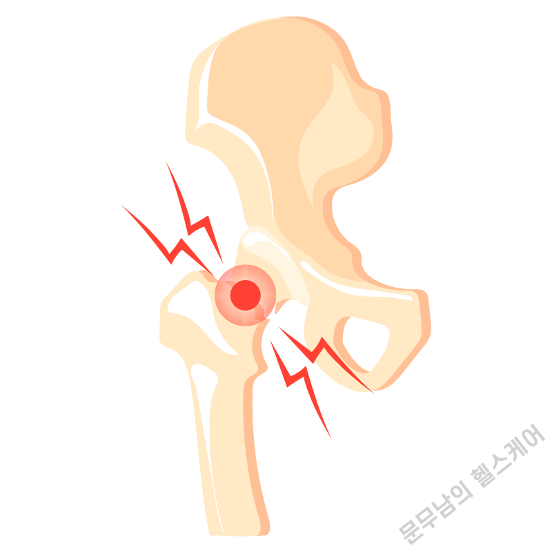 골반 고관절 뚝뚝 소리 나는 이유는?
