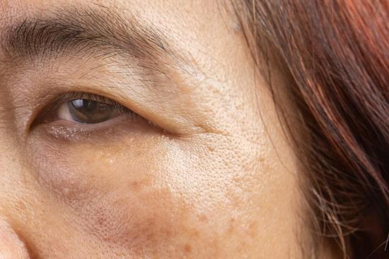 다크스팟 &amp; 색소침착 제거 &ndash; 미백 시술 종류 정리