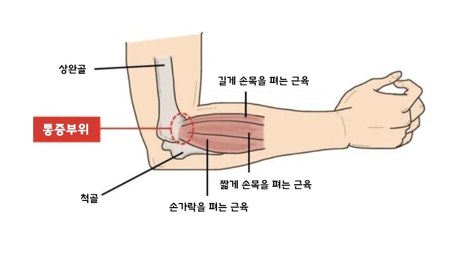 골프외측상과염 통증부위
