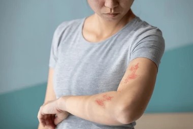 대상포진 예방접종 가격 평균가
