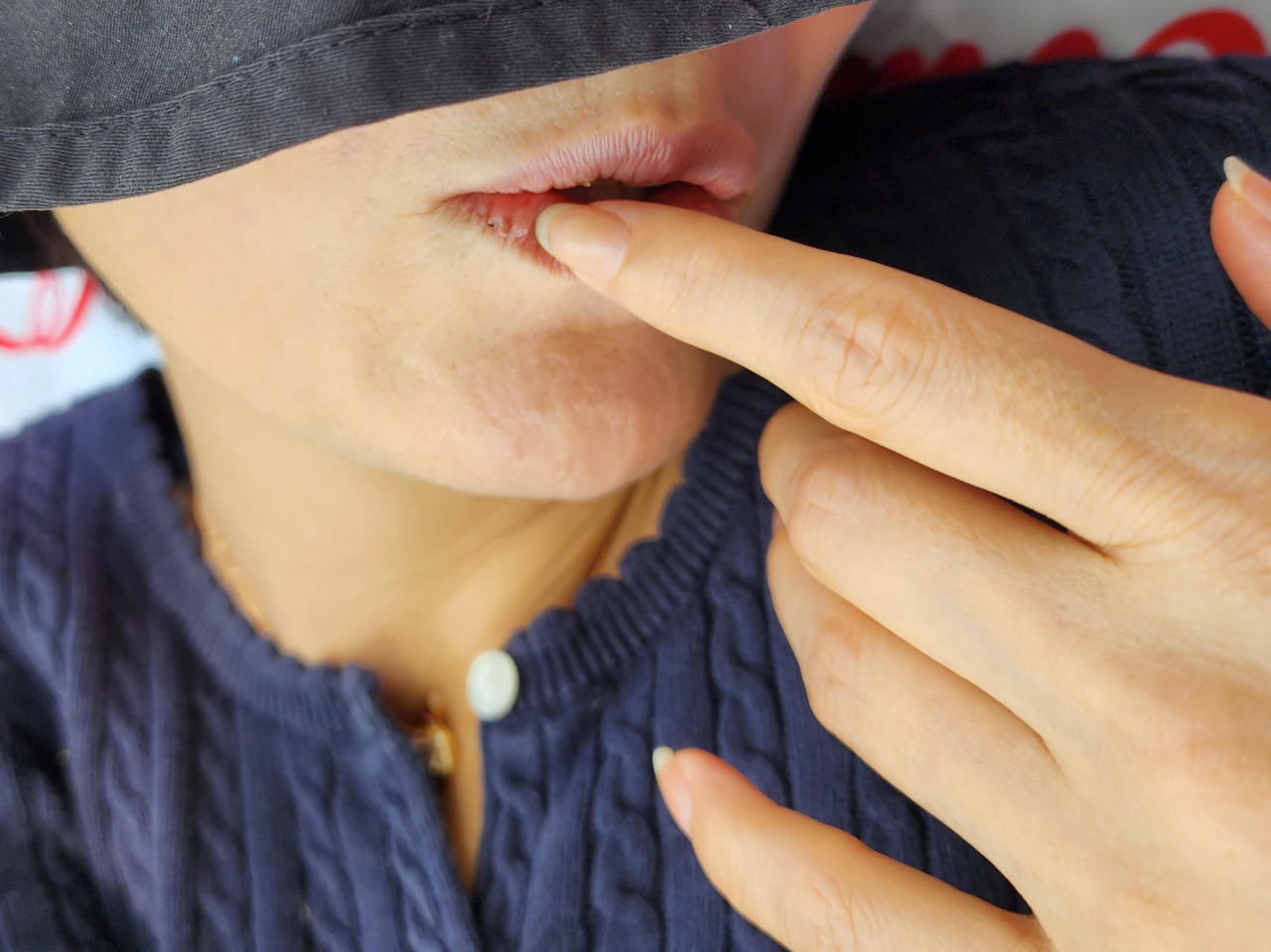 아시클로버 연고 효능 가격 입술 단순 포진 헤르페스 바이러스 치료제