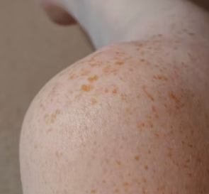 대상포진 초기증상 원인 예방 관리법