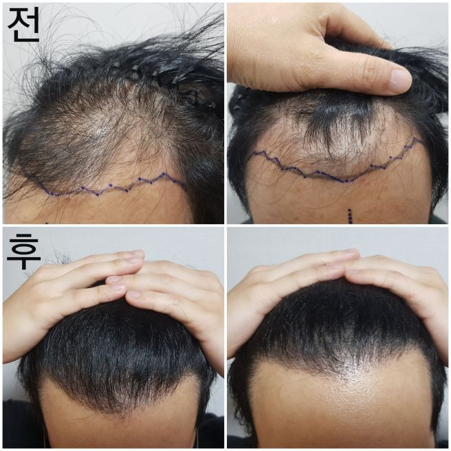 한상보 탈모의사가 말하는 모발이식